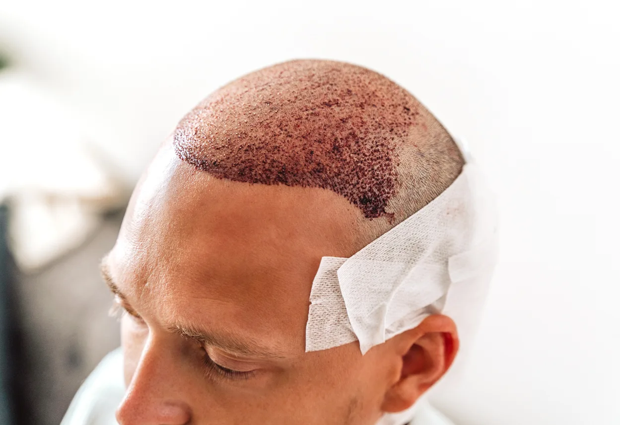 Patient undergoing FUE hair transplant procedure in Turkey with a specialist surgeon in a modern clinic.