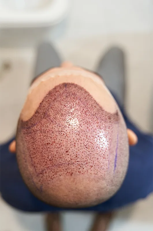 Decoding hair transplant