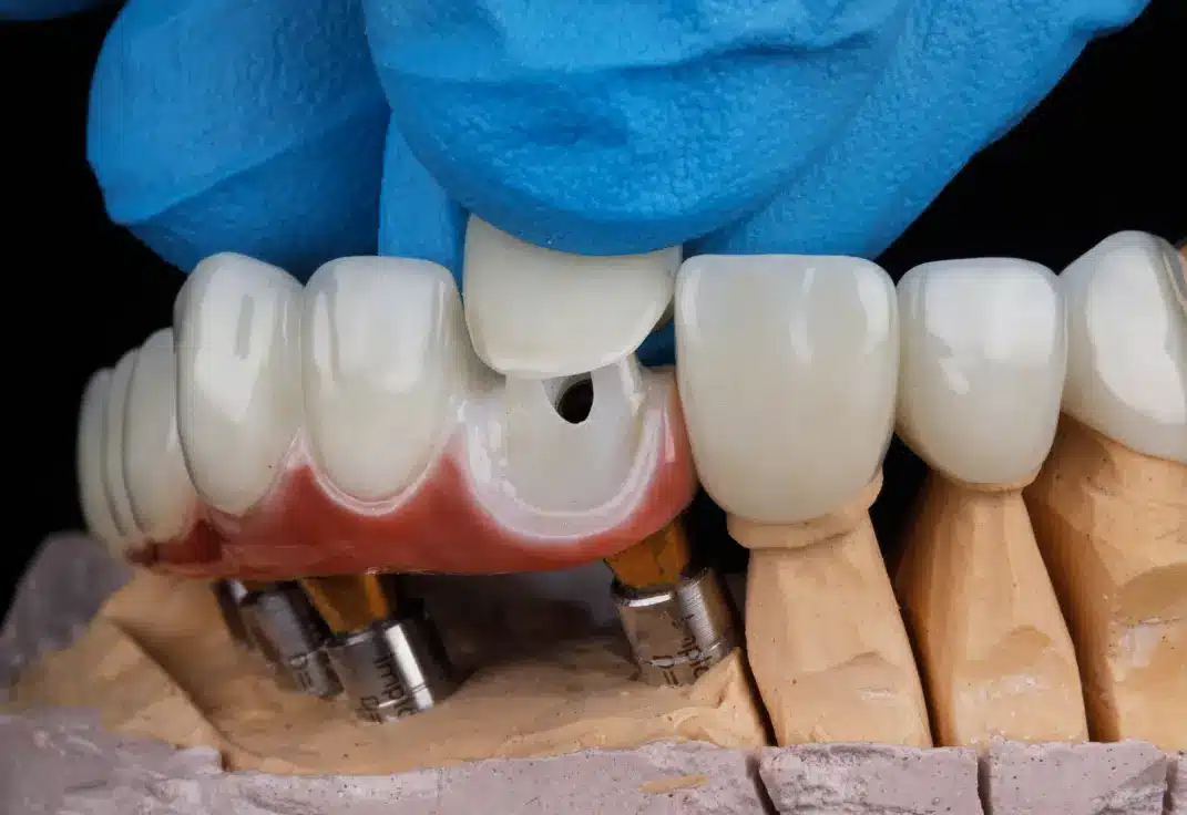 Comparación entre carillas vscoronas dentales para tratamientos en Turquía.