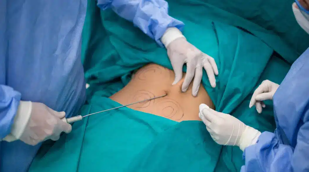 Cirujano realizando liposucción en Turquía